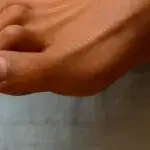 Close-up of foot with hammer toes showing second toe bent downward.